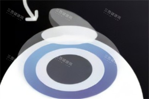 半飛秒制作角膜瓣