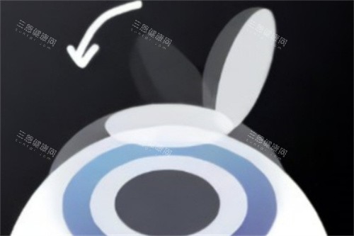 半飛秒蓋回角膜瓣