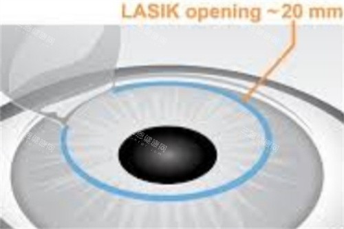 半飛秒制瓣示意圖