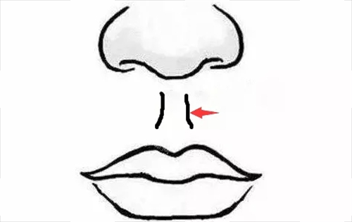 人中縮短術(shù)部位展示