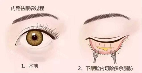 昆明李韜做眼袋怎么樣？避開(kāi)瞼外翻/凹陷/臥蠶消失，修復(fù)成功幾率92%