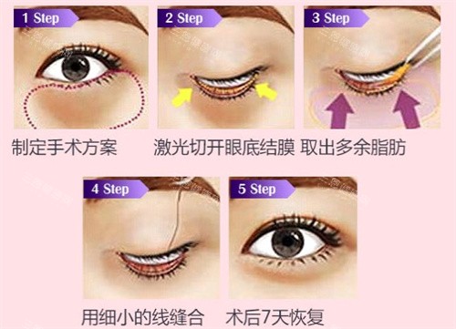 去眼袋手術(shù)過程