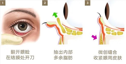 內(nèi)切去眼袋