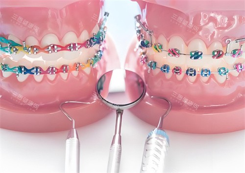 牙齒矯正模型圖片