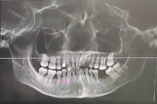 牙周炎 牙齦萎縮 缺牙