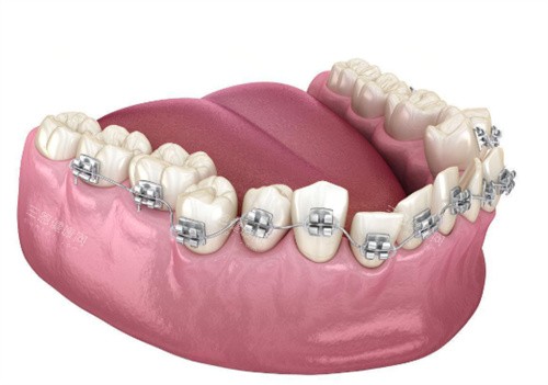 金屬牙齒矯正展示圖