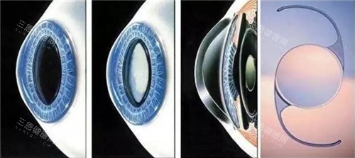 白內障晶體手術細節(jié)圖