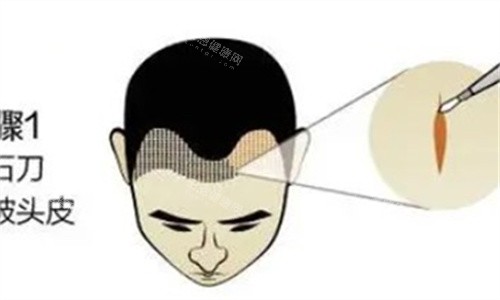 植發(fā)際線
