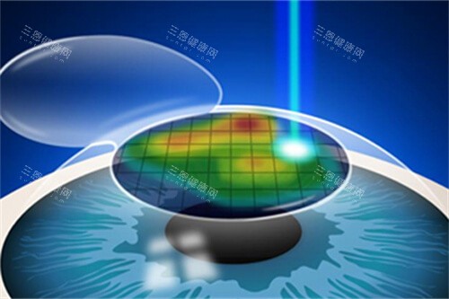 近視手術(shù)漫畫示意圖