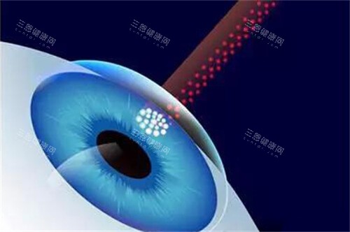 近視眼手術(shù)漫畫示意圖