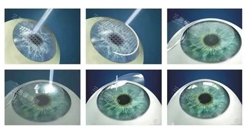 飛秒手術(shù) (2) 飛秒手術(shù) (2)