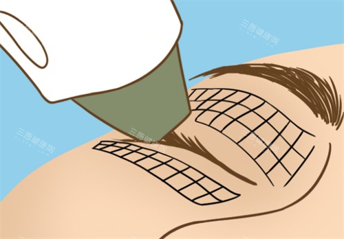 熱瑪吉眼部抗衰過(guò)程圖解