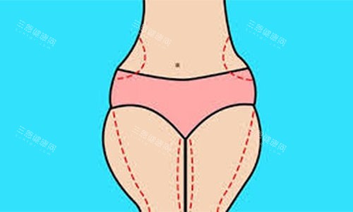 大腿吸脂手術(shù)設計方案示意圖