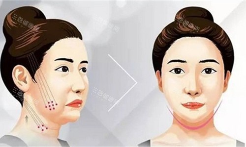 埋線提升卡通圖