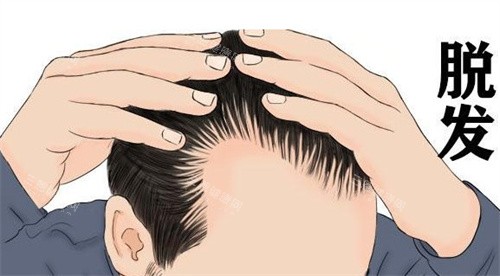 發(fā)際線后移 發(fā)際線后移