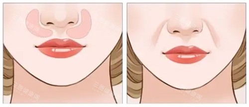 口周老化對面部影響