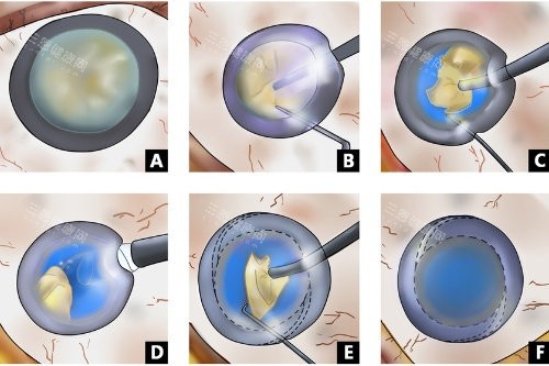 超聲乳白內(nèi)障手術(shù)