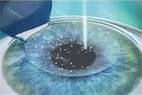 半飛秒手術(shù)