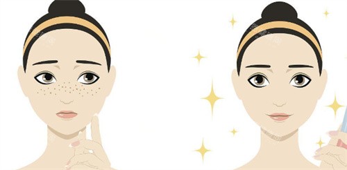 激光祛斑對(duì)比示圖