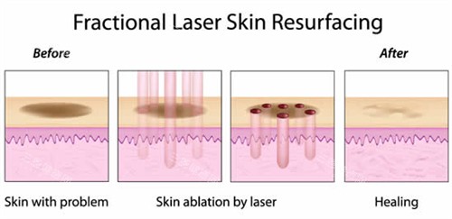 激光祛斑流程圖