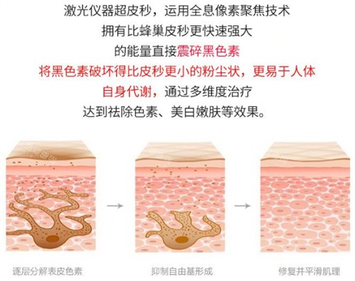 激光祛斑前后的對(duì)比