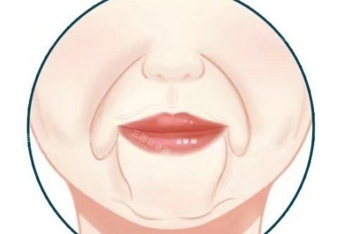 口角囊袋卡通圖