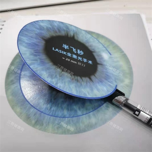 半飛秒Lasik激光手術(shù)