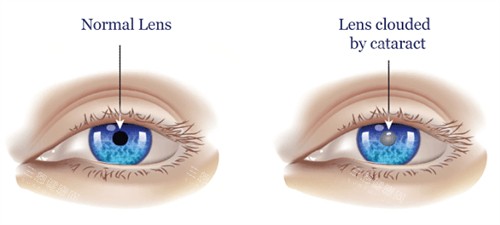 正常眼睛和白內(nèi)障眼睛的區(qū)別