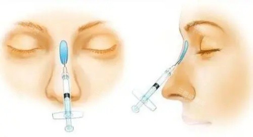 瑞婭玻尿酸注射示意圖