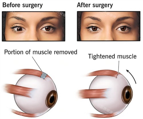 斜視手術(shù)原理展示