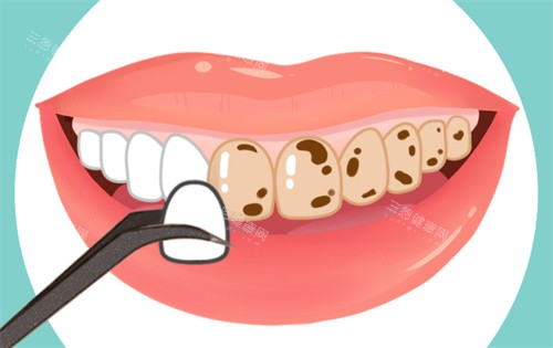 牙齒貼面動(dòng)畫(huà)圖