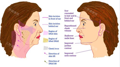 面部提升手術(shù)對(duì)比圖