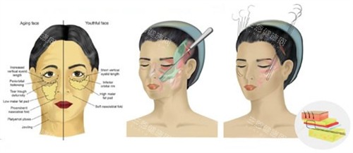 面部提升手術(shù)過(guò)程